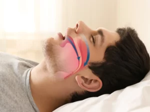 Sleep Apnea